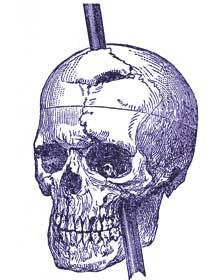 Phineas Gage&#39;s Skull